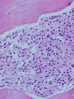 Mastocytoza układowa – rzadka przyczyna hepatosplenomegalii